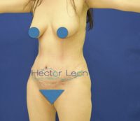 lipecto.002b lipecto.002b