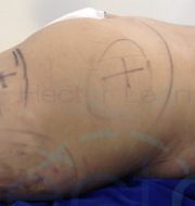 001-gluteoplsatia-antes