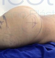 001-gluteoplsatia-despues