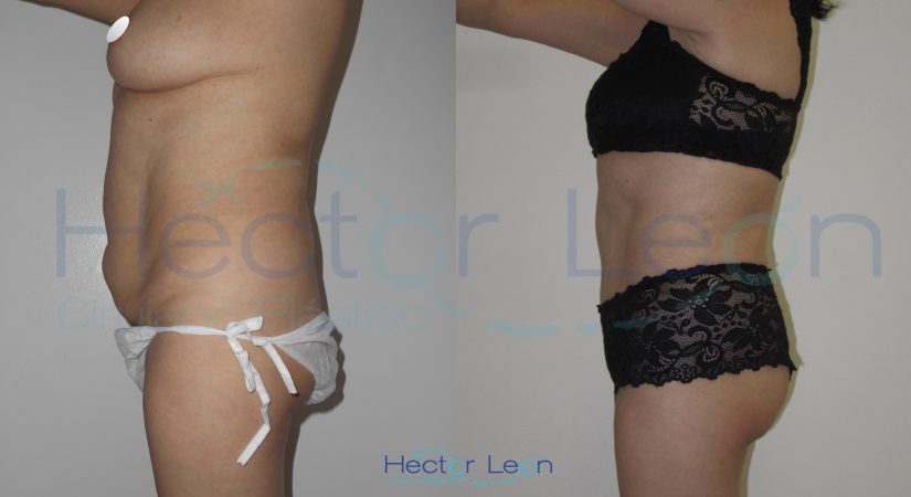 005-abdominoplastia 005-abdominoplastia