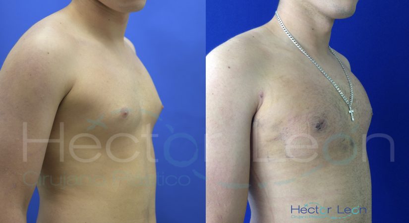 008-ginecomastia