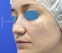 011-rinoplastia-antes