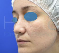 011-rinoplastia-antes 011-rinoplastia-antes