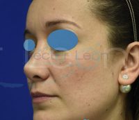 011-rinoplastia-despues