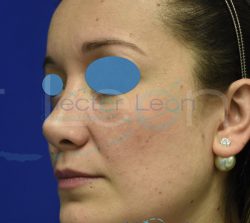011-rinoplastia-despues 011-rinoplastia-despues