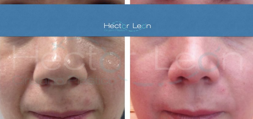 014-rinoplastia 014-rinoplastia