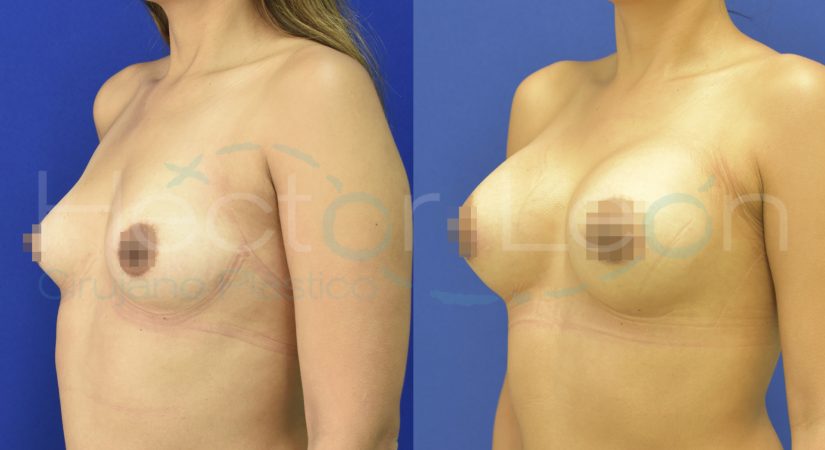 3 mamoplastias.001 3 mamoplastias.001