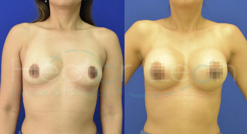3 mamoplastias.002 3 mamoplastias.002