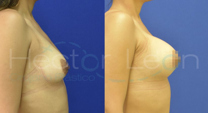 3 mamoplastias.003 3 mamoplastias.003