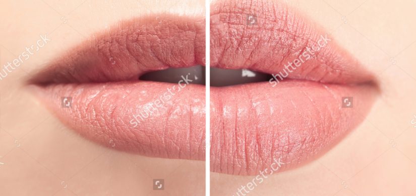 female-lips-before-after-augmentation-procedure-660509344 female-lips-before-after-augmentation-procedure-660509344