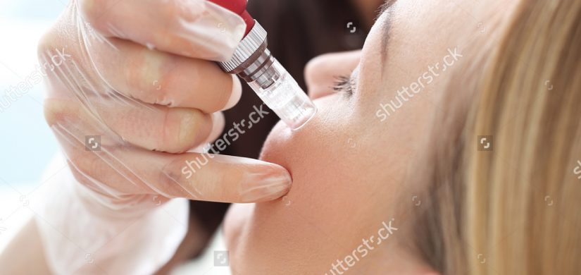 needle-mesotherapy-face-lift-microneedle-treatment-583305439 needle-mesotherapy-face-lift-microneedle-treatment-583305439