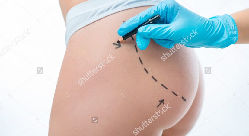 plastic-surgeon-drawing-lines-on-body-376695166