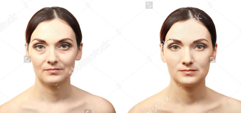 woman-face-before-after-cosmetic-procedure-548884114